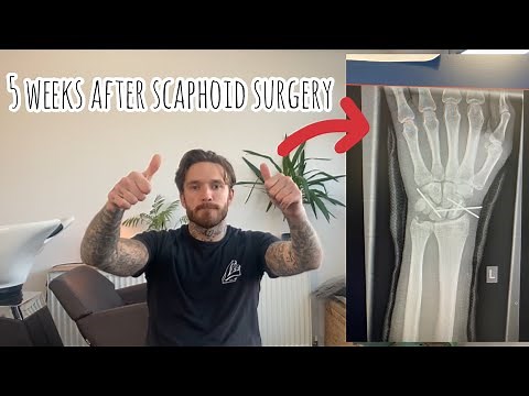 Scaphoid fracture recovery: 5 weeks after surgery
