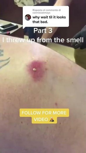 Cystic Acne Removal & Inflammatory Acne