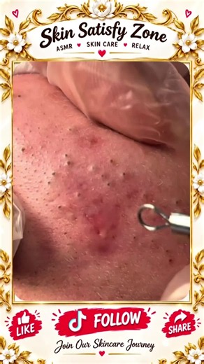Deep Blackhead Extraction & Satisfying Popping | Wait for the most satisfying pop 😳🫣 You won’t believe what comes out! #pimplepoppersatisfying #Acne #pimple #Blackhead #Satisfying