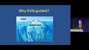 Endoscopic Treatment of Gastric Varices