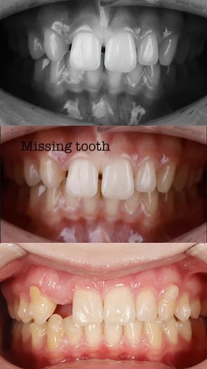 9.6K views · 155 reactions | Timelapse of MSE EXPANSION CASE with creating space for missing tooth #7 with aligners #maw #marpe #fme #dejovalorthodontics #airwayorthodontics #boca #bocaraton | Svitlana Koval Dmd | Facebook