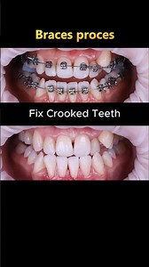 Braces process. 24 months to fix crooked teeth case #braces #dentist #orthodontist