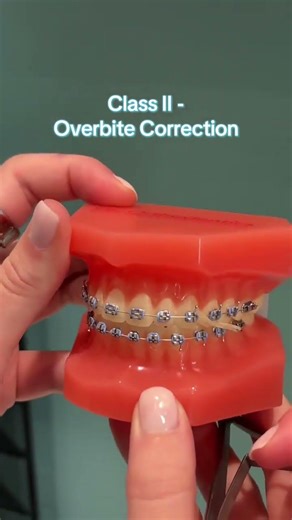 How to Wear Elastics