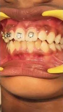 Self ligating brackets .dream smile uploading#dentalcare #orthodontist #smiledesigndental #aesthetic