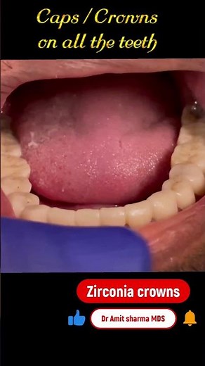 Caps / crowns placed on all lower teeth