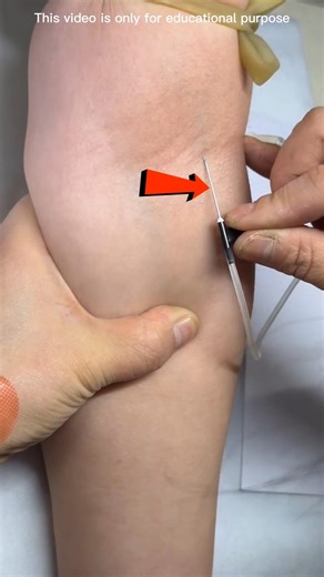 Needle Insertion in the hand😱🤯#shorts #viral #trending #viralshorts #education #viralvideos #popular