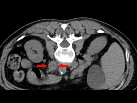 Gangi-SoftGuard® coaxial needle for interventional radiology