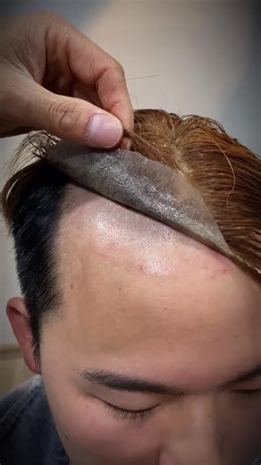 Discover the Best Non-Surgical Hair Replacement Solutions