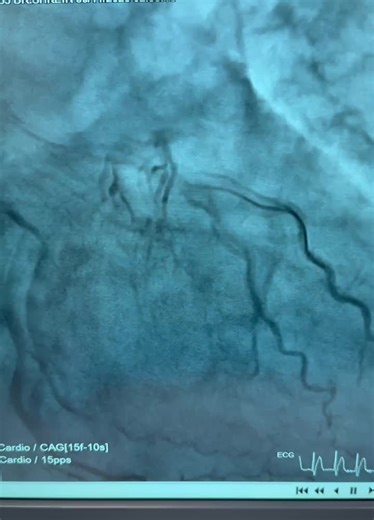 #cardiology #interventionalcardiology #stemi #lad #pci #savinglives #cathlablife #proceduralexcellence #acutemi | Mohamad-Omar Choukair, MD