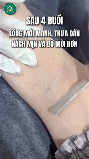 TẠM BIỆT THÂM NÁCH – CHỈ 499K TẠI TMV HOA ANH| Đào Ngọc Anh { Thẩm Mỹ }