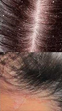It's not just dandruff, it could be an illness 😮