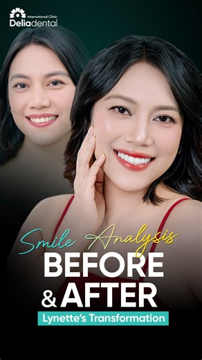 HOW MUCH CAN A SMILE REALLY CHANGE? 📋Before dental treatment, Lynette’s smile struggled with discoloration, uneven shapes, and worn edges — details that quietly affected both her confidence and daily comfort. After her ceramic smile makeover, the change wasn’t just visible. ✅Brighter color. ✅More balanced tooth shape. ✅A smoother smile line. ✅Stronger teeth that allow comfortable chewing every day. This is what the right dental solution can do — not only improving how a smile looks, but how it 