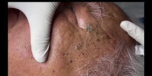 Managing Infected Blisters: Causes and Treatments