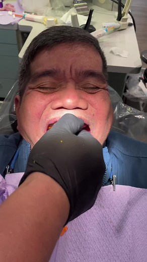 Does your #denture do this? Dr. Cortes is the only trained dentist on the West Coast of the #USA to perform this procedure for #edentulous #patients. #SuctionDenture is life changing, allowing a better quality of life for people who may not be ideal candidates for #dentalimplants. #lowersuctiondenture #sandiegodentist