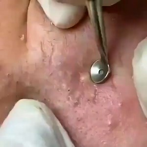 Blackheads&Cyst | ⚠️Follow @blackheads.cyst for more videos ⚠️ . . . #pimple #acne #skincare #blackheads #pimples #pimplepopping #pimplepopper #whiteheads... | Instagram