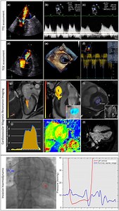Four-dimensional flow cardiovascular magnetic resonance for the assessment of mitral stenosis