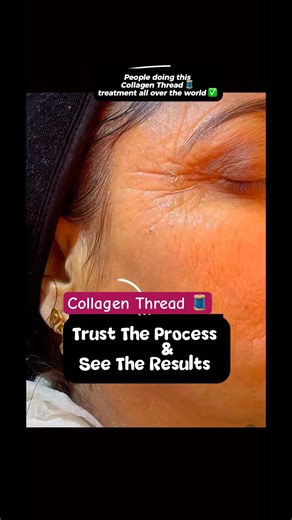 Collagen Thread 🧵 Anti-aging Treatment #skincare #collagen #antiaging #skincareproducts #fypシ