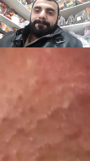 Effective Blackhead Removal Techniques