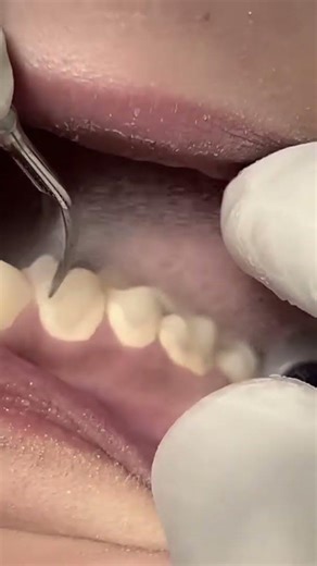 Scaling teeth to remove tartar and calculus shorts