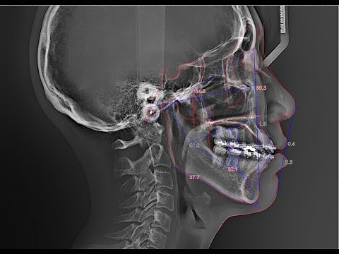 WillCeph- Automated Cephalometric Analysis Software