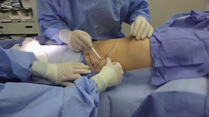 Potential Benefits and Results with a Mommy Makeover (GRAPHIC)