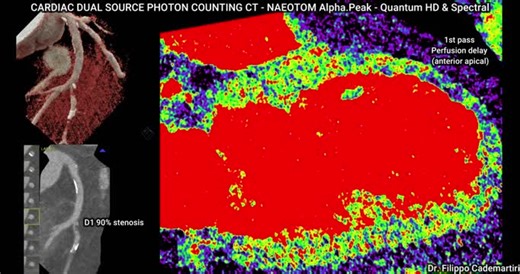 #photoncountingct #cardiacimaging #radiologyinnovation #ctrevolution #spectralimaging #cardiology #precisionmedicine #radiology #contrastmedia #100micronct #aiinimaging #valuebasedcare #cardiacct… | Dr. Filippo Cademartiri | 21 comments