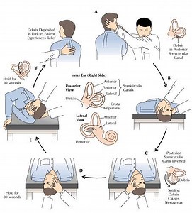 Youtube vertigo treatment epley maneuver