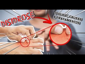 🔴SE VOCÊ VIR ESTAS BOLINHAS NAS MÃOS E NOS PÉS, VOCÊ PODE TER ESSA CONDIÇÃO DE PELE