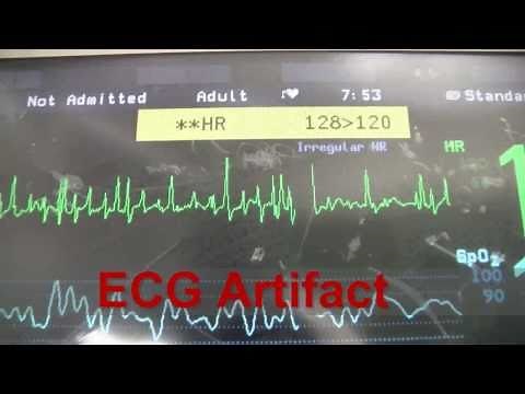 ECG Artifact