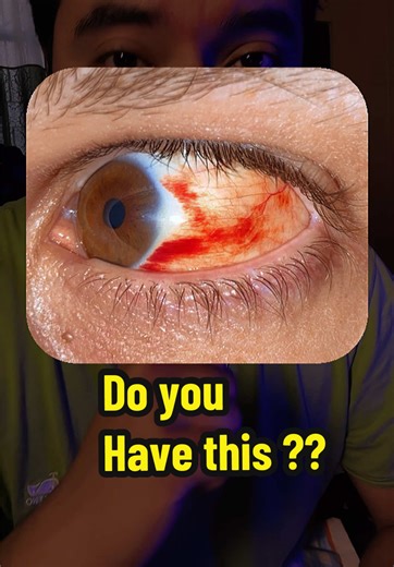 Understanding Subconjunctival Hemorrhage