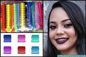 Best Braces Color For Light Skin: How To Choose - Orthodontic Braces Care