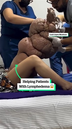 732K views · 1.1K reactions | Helping patients with lymphedema  | VT | Facebook