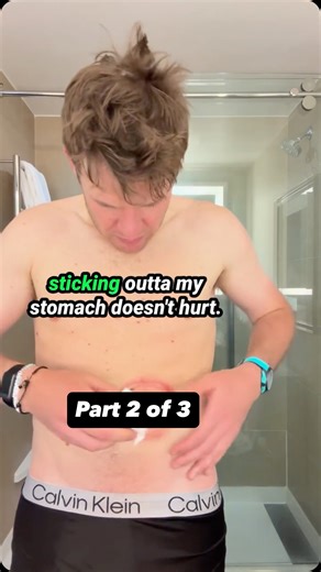 ⚠️ Medical imagery warning: visible stoma and skin care routine. Part 2 of 3: Stoma prep and reapplication. I showered, dried off, and started using stoma powder and medical adhesive to protect the skin and get a better seal. It’s not painful, even though my large intestine is literally sticking out of my stomach. Just part of life now. This is what living with an ostomy really looks like. Part 3 tomorrow, applying the new bag and finishing the setup. #OstomyAwareness #CrohnsWarrior #OstomyLife 