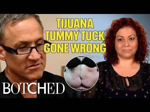 Massive Infected Wound Left After Evelyn's Tijuana Tummy Tuck (Before & After) | Botched | E!