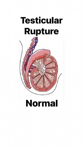 Testicular Rupture #urology #resident #medstudent