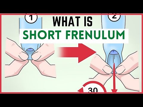 Frenulum Breve (Short frenulum): Signs & symptoms, Treatment (frenectomy of foreskin)