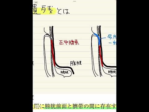尿膜管遺残感染