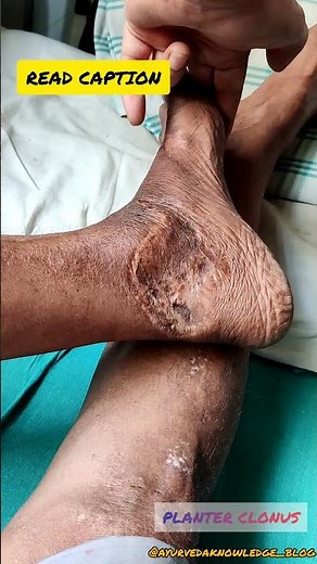 PLANTER CLONUS..Clonus is a type of neurological condition ates involuntary muscle contractions.