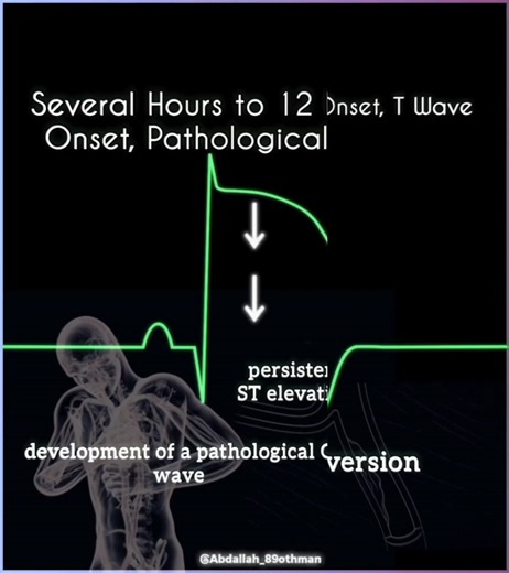 17K views · 195 reactions | 變MI ECG Timeline: Acute ST elevation (hrs), pathological Q waves (12h), T wave inversion (days-wks), chronic Q wave persistence (mos-yrs). ST normalizes by 1 mo, T waves by 1 yr. See the progression! #Cardiology #ECG #heartattack #MyocardialInfarction #fblifestyle #CardioEd | Abdallah Othman | Facebook