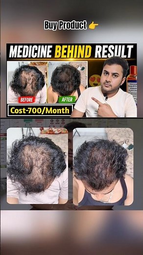 Hair Regrowth Madicine 💊
