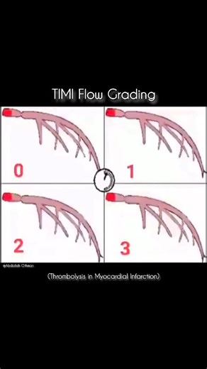 Abdallah Othman on Instagram: "📌 TIMI Flow Grading: A Vital Metric for Coronary Perfusion 📌 TIMI (Thrombolysis in Myocardial Infarction) flow grading remains a cornerstone for assessing coronary artery perfusion post-PCI, updated as of July 2025. TIMI 0 (No Flow): Complete occlusion, no antegrade flow beyond the blockage. TIMI 1 (Penetration without Perfusion): Minimal flow past occlusion, inadequate for distal opacification. TIMI 2 (Partial Flow): Delayed yet complete distal ves
