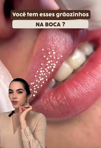 O que são grânulos de Fordyce e como identificá-los?