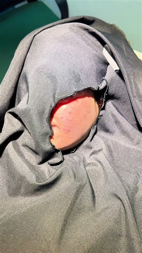 Before & after dimple formation done under local anasthesia due to local anathesia effect & soft tissue edema the depth of dimple & movement of muscle is less it will improve with time as the edema settled down & effect of anasthesia resoloved . , , , #dimples #dimplegirl #dimple #peshawar #kpk @Rejuva Aesthetics clinic @Muskan Khan