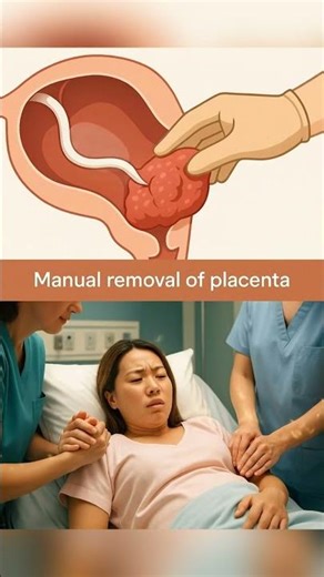 Manual Removal of Placenta, What Really Happens #shorts #miracleinmotion #childbirth