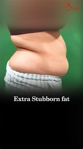 Abdomen Liposuction for a Toned Midsection | Liposuction Result #bellyfat