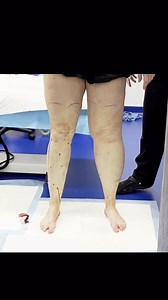 “They look even skinnier than I thought!” This is the power of real-time sculpting with Dr. Su’s 360° Cankle and Knee Liposuction. 🌟 What you’re hearing is pure disbelief — seeing bulky, heavy calves instantly transformed into sleek, defined legs right before her eyes. No filters. No months of waiting. The difference happens right there on the table. 👏 By addressing fat from every angle — front, sides, back — and removing it close to the muscle, Dr. Su creates a natural taper that restores the