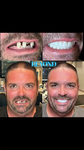 A smile upgrade that brought back comfort, function, and confidence! WOW! 朗 ♥️ Transformations like this are why we do what we do.  Beyond Dental & Implant Center | Beyond Dental & Implant Center | Facebook