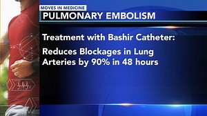 Bashir Endovascular Catheter aims to improve speed, efficacy in treating blood clots