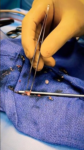 I Found These Silicone Balls Inside a Patient’s Buttocks 🍑🫢