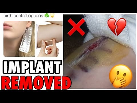 BIRTH CONTROL IMPLANT REMOVAL PROCEDURE!